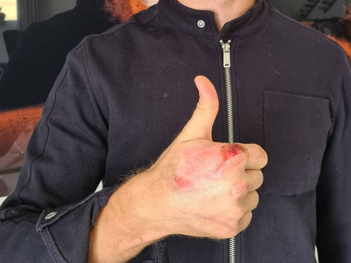 Foto zur News: Romain Grosjean zeigt Grad seiner Verbrennungen auf Social Media