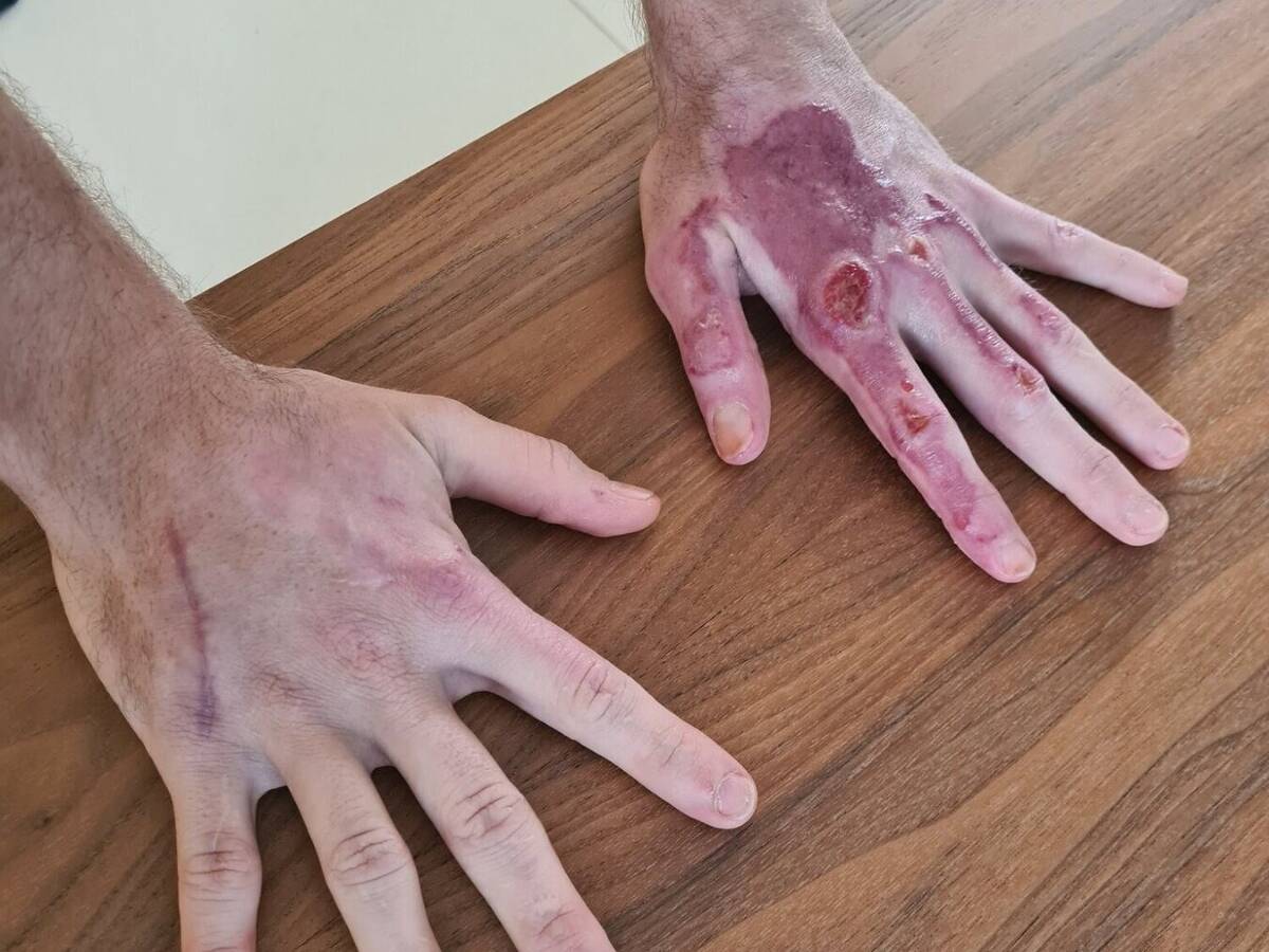 Foto zur News: Ohne Handverband: Grosjean zeigt seine Wunden nach dem Feuerunfall