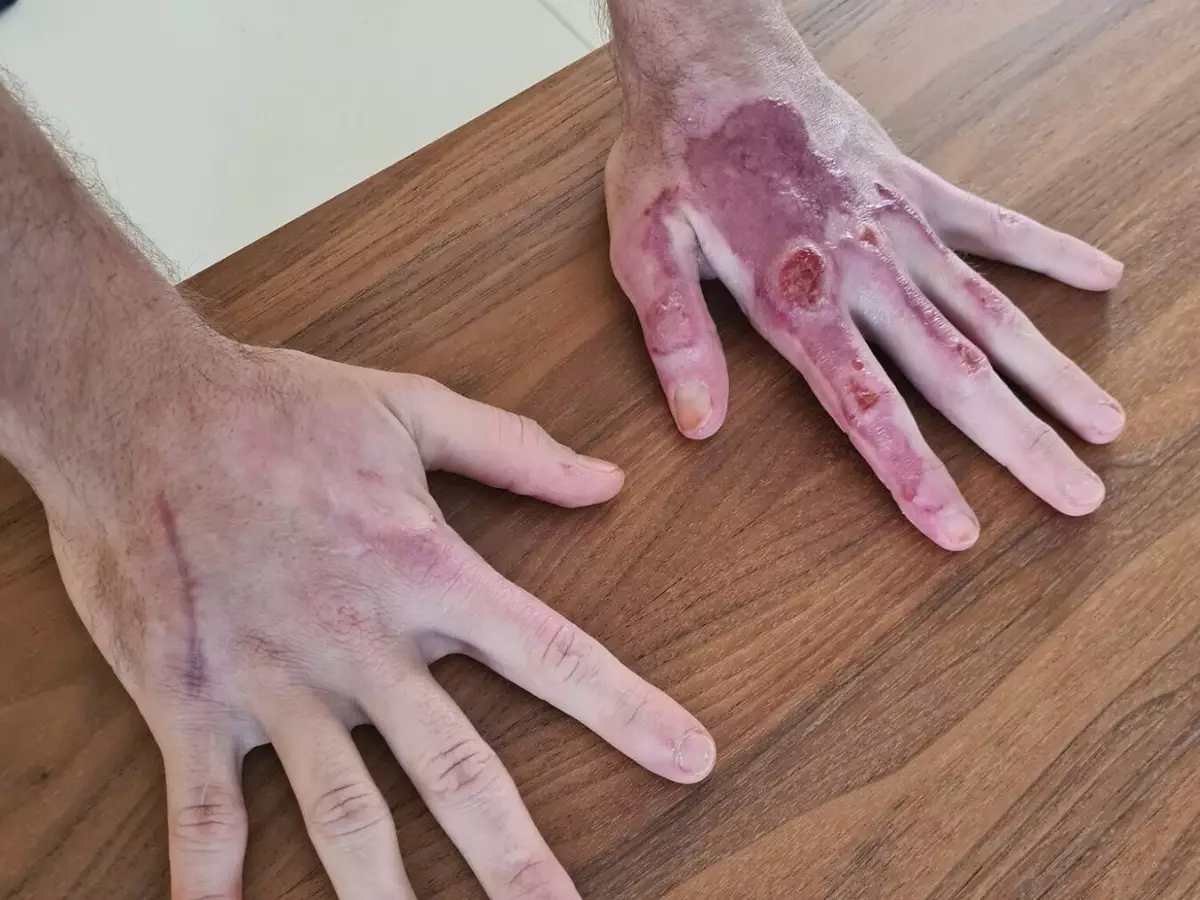 Romain Grosjean Foto zur News: Ohne Handverband: Grosjean zeigt seine Wunden nach dem Feuerunfall
