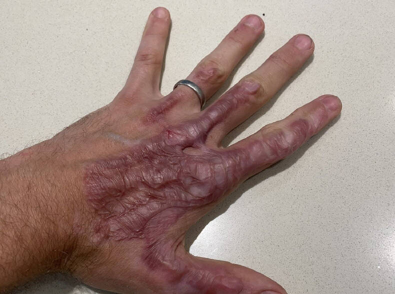 Foto zur News: Romain Grosjean: Neue Haut für die linke Hand